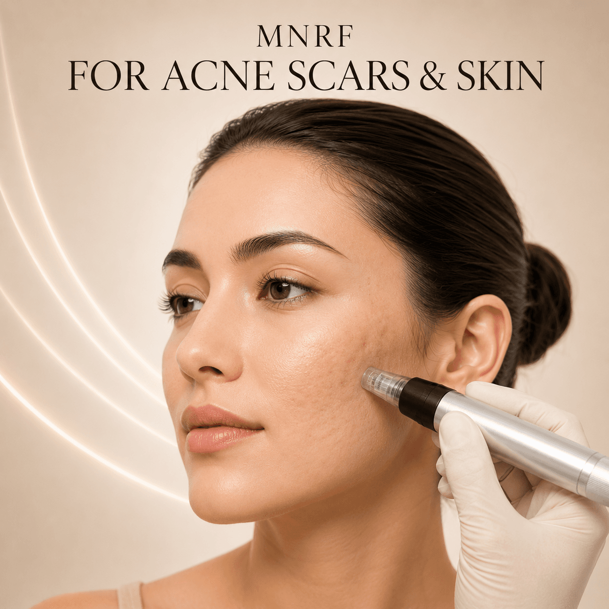 MNRF for Acne Scars & Skin
